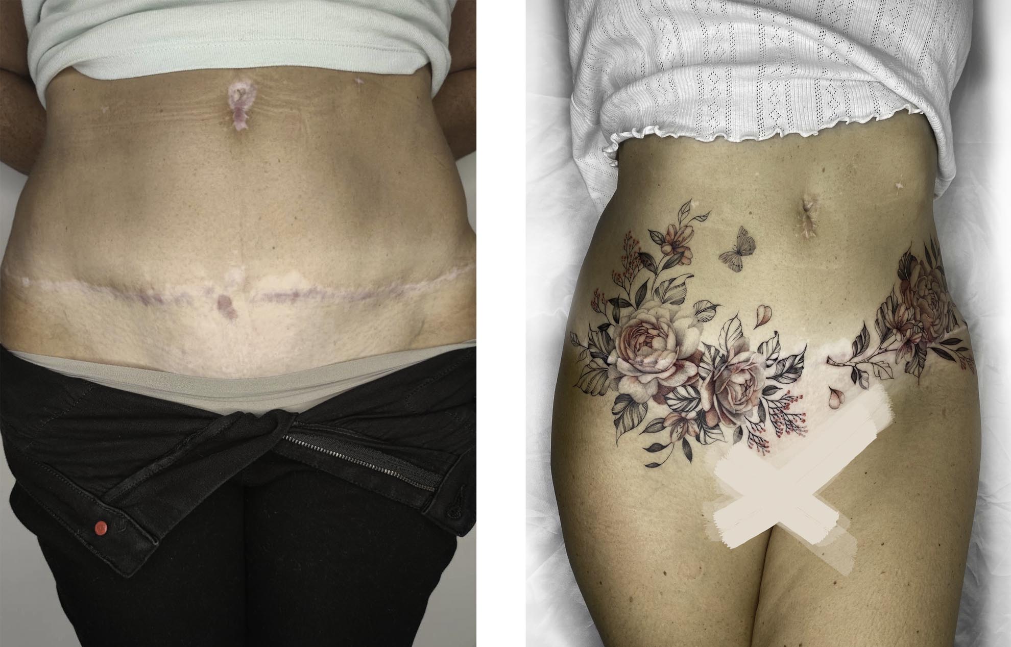 Tummy Tuck Scar Tattoo  ILLUSIONS BY INK STUDIO